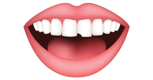 chipped-tooth