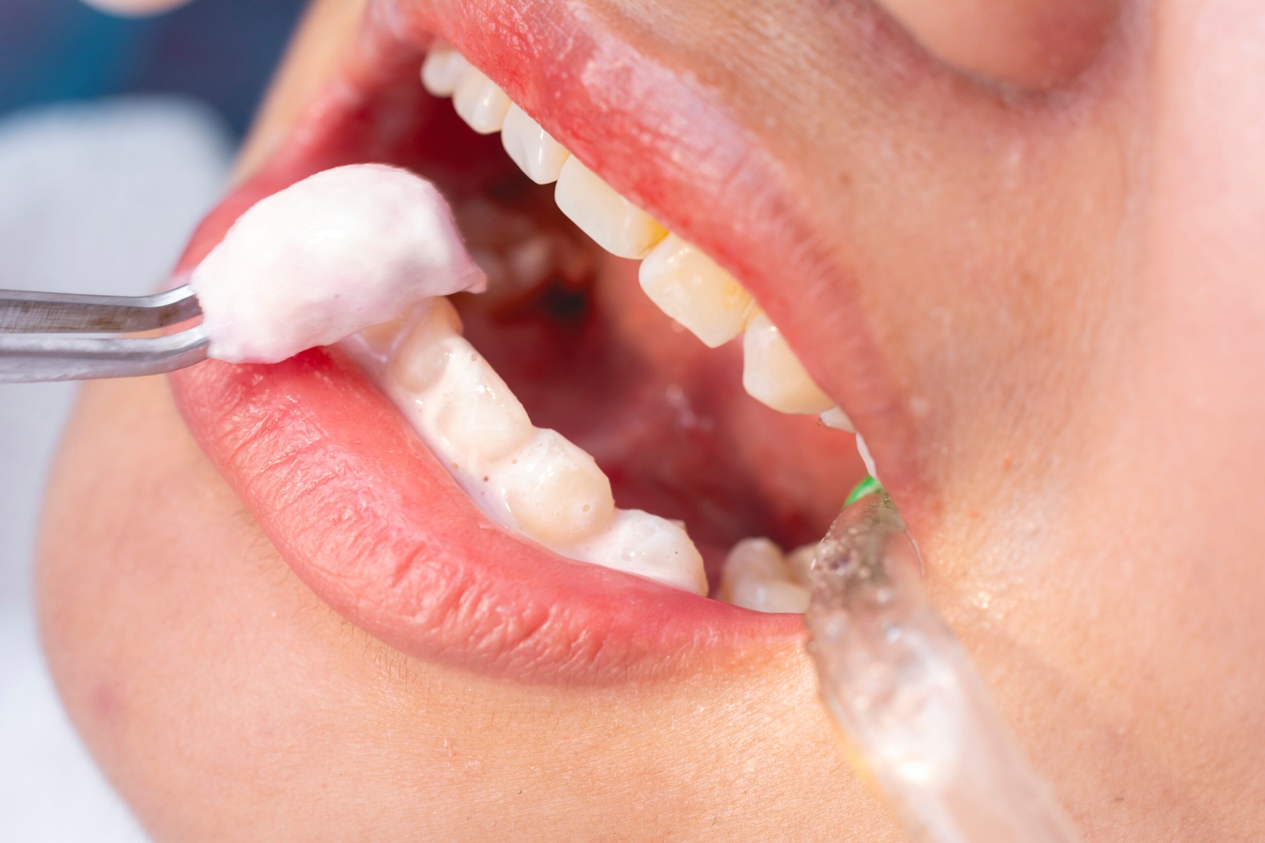 The Role of Fluoride in Dental Cleanings